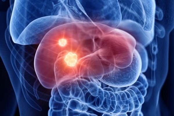 Ngộ nhận về chế độ ăn kiềm hóa đẩy lùi bệnh ung thư-1