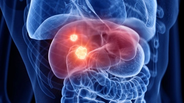 Ba tín hiệu lạ cảnh báo ung thư đại tràng giai đoạn cuối-2