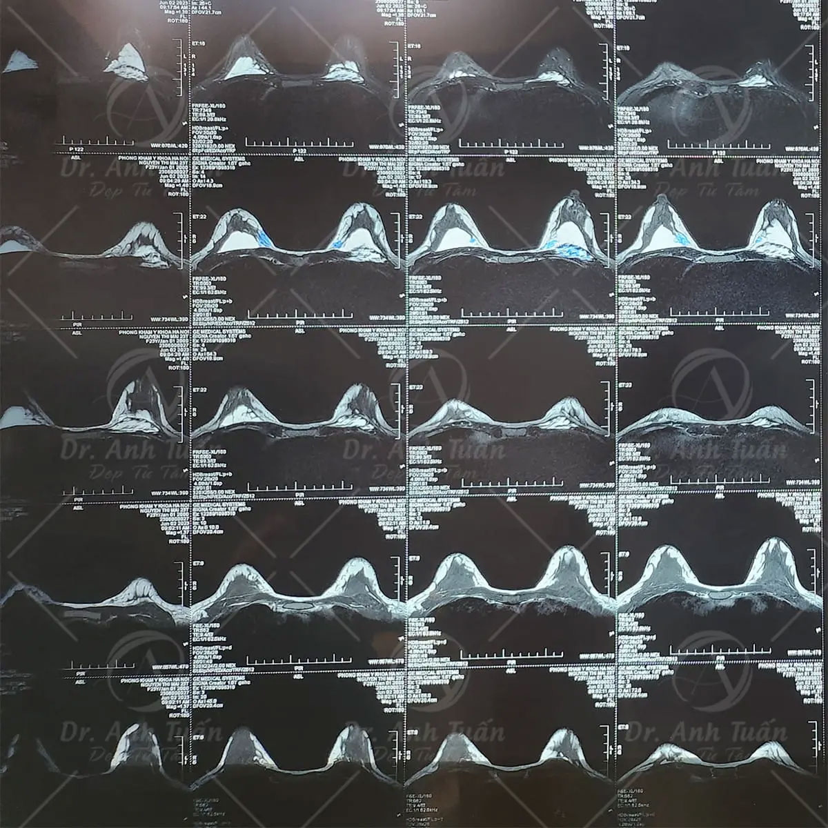 Nâng cấp vòng 1” không cần phẫu thuật, bác sĩ cảnh báo cẩn trọng kẻo tiền mất tật mang-1