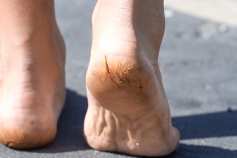 Dấu hiệu ở bàn chân chứng tỏ bạn đang có đường huyết quá cao-1
