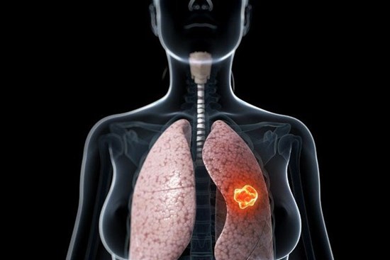 Dấu hiệu ung thư phổi không liên quan đến đường hô hấp