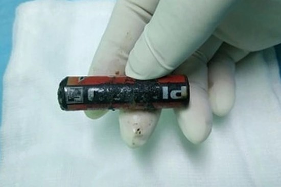 Cọ xát pin vào nhau, bé trai bị pin nổ phải nhập viện