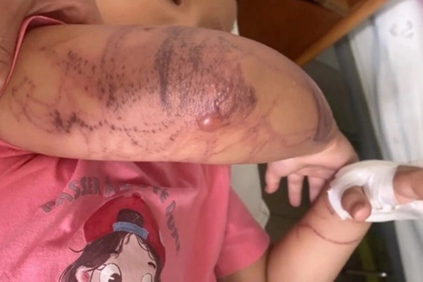 Bị sứa đốt khi tắm biển, bé 7 tuổi nhập viện trong tình trạng mất ý thức-1