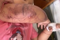 Bị sứa đốt khi tắm biển, bé 7 tuổi nhập viện trong tình trạng mất ý thức