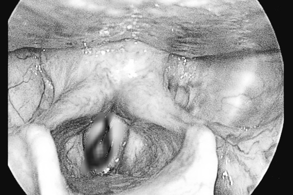 Ngạt mũi, chảy máu mũi suốt 2 tuần vì dị vật sống làm tổ trong mũi-2