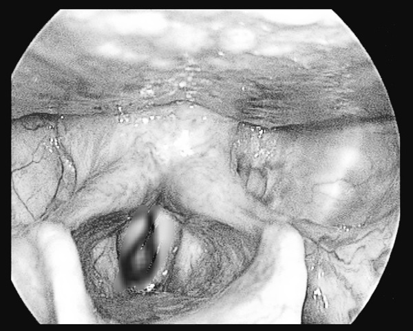 Con đỉa to bằng ngón tay bám chặt cổ họng người đàn ông-1