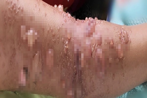 TPHCM: Hàng loạt người vào viện cầu cứu vì đi tắm biển gặp họa bỏng sứa-2