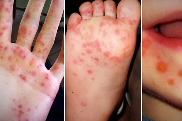 Cảnh giác với chủng virus tay chân miệng nguy hiểm đang gia tăng, nhiều trẻ không có biểu hiện rõ ràng, khó phát hiện-2