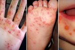 Cảnh giác với chủng virus tay chân miệng nguy hiểm đang gia tăng, nhiều trẻ không có biểu hiện rõ ràng, khó phát hiện-2