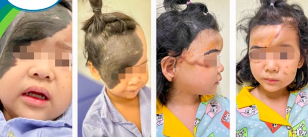Căn bệnh rất hiếm gặp khiến cô bé có làn da trâu phủ nửa mặt-1