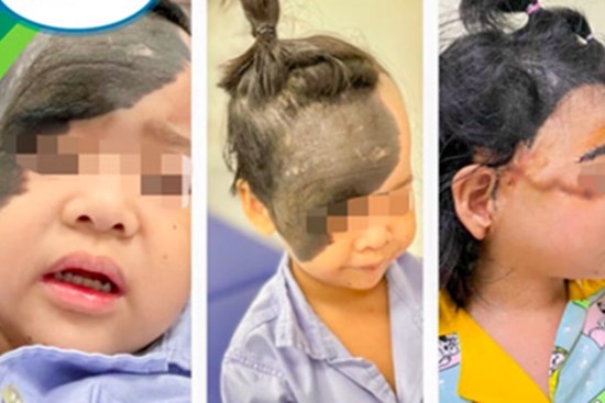 Căn bệnh rất hiếm gặp khiến cô bé có làn 'da trâu' phủ nửa mặt
