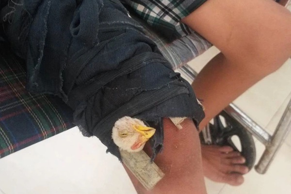 Chuyện lạ, bắt gà cắt tiết rồi buộc vào chân để chữa... gãy xương đùi-1