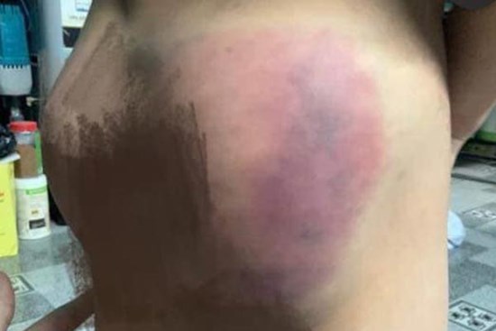 Phụ huynh ở Nha Trang tố giáo viên đánh cháu bé chảy máu miệng, bầm mình