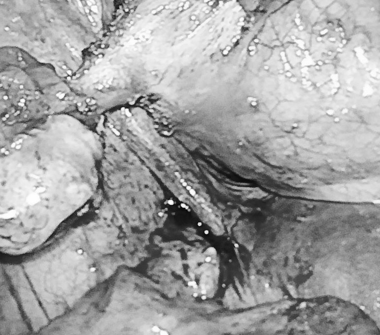 Nữ bệnh nhân mắc chứng bệnh hiếm gặp, đi tiểu ra những sợi tóc-1