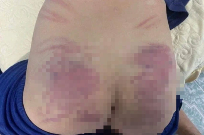 Vụ bé trai tự kỷ nghi bị cô giáo bạo hành: Người mẹ lên tiếng-1