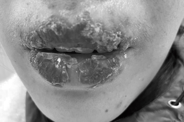 Nữ sinh 15 tuổi ‘nát’ môi vì theo chị đi xăm-1