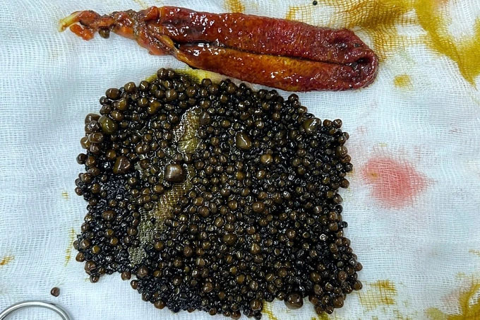 Cụ bà ở miền Tây sống với túi mật chứa 1.100 viên sỏi suốt 3 năm-1