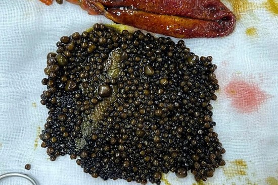 Cụ bà ở miền Tây sống với túi mật chứa 1.100 viên sỏi suốt 3 năm