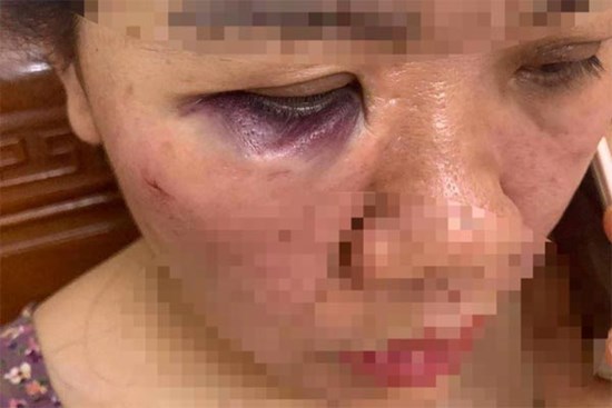 Nữ cán bộ điện lực bị đồng nghiệp đánh thâm tím mắt