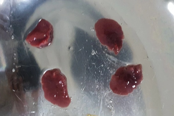 Bác sĩ mất 7 tiếng lấy sán não dài 10cm ký sinh 13 năm trong não, giúp chàng trai thoát khỏi bại liệt kéo dài-2