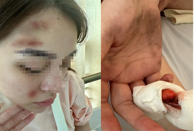 Một cảnh sát hình sự bị bạn gái tố hành hung gây thương tích-1