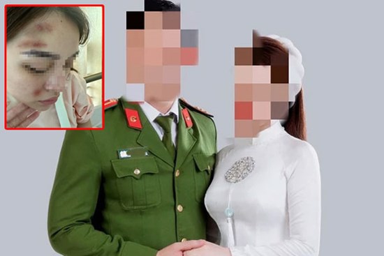 Một cảnh sát hình sự bị bạn gái tố hành hung gây thương tích