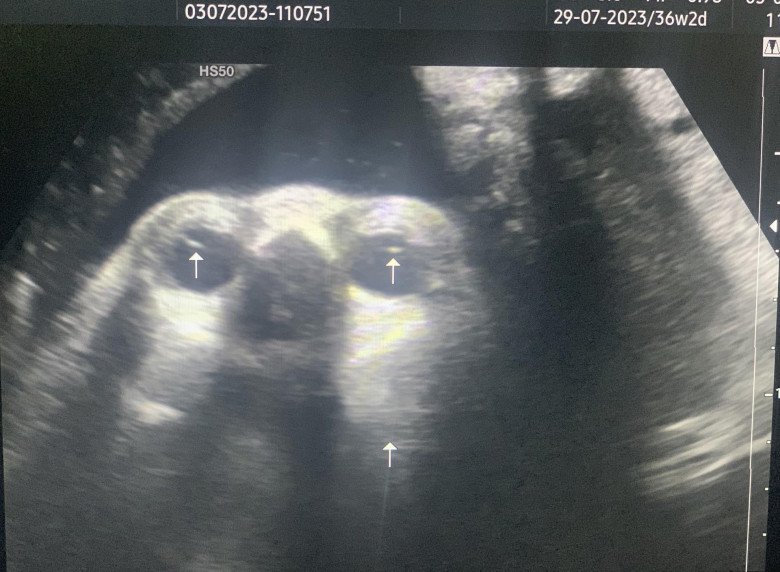 Mẹ bầu ôm mặt khóc khi biết thai nhi 34 tuần tuổi bị đục thủy tinh thể: Bác sĩ chỉ ra việc quan trọng cần làm-1