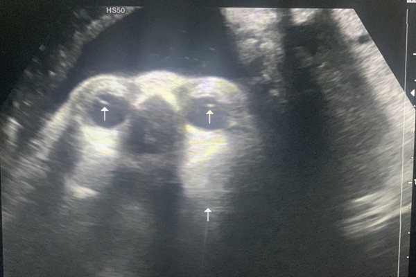 2 tuổi đã bị đục thủy tinh thể: Bác sĩ khuyến cáo trẻ có dấu hiệu sau cần đưa đi khám-3