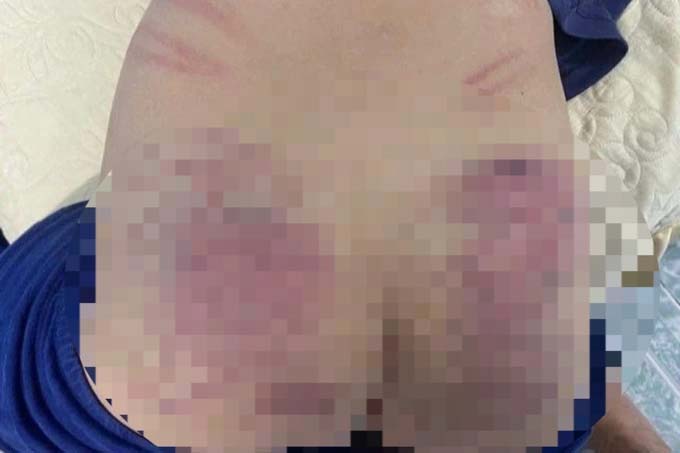 Dấu hiệu hình sự vụ bé trai 9 tuổi chậm phát triển nghi bị bạo hành-1