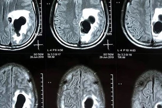 Tưởng bị tâm thần, hóa ra sán làm tổ trong não