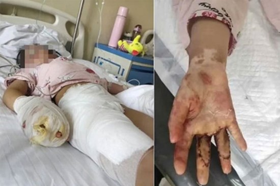Cãi nhau với chồng, mẹ kế hành hạ con chồng đến mức tàn tật