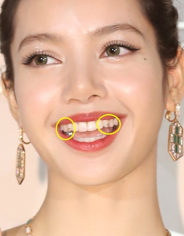 Trend răng đính đá” được Lisa và loạt idol mê mẩn dạo này bỗng gây tranh cãi-2