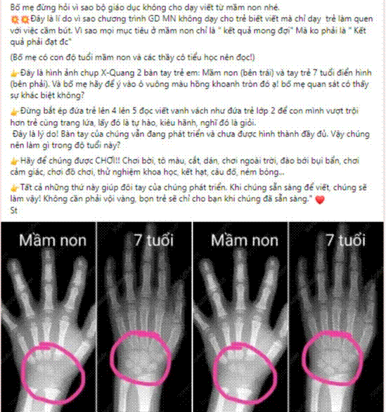 Cho trẻ tập viết quá sớm sẽ ảnh hưởng đến sự phát triển của xương: Bác sĩ chuyên khoa nói gì?-1