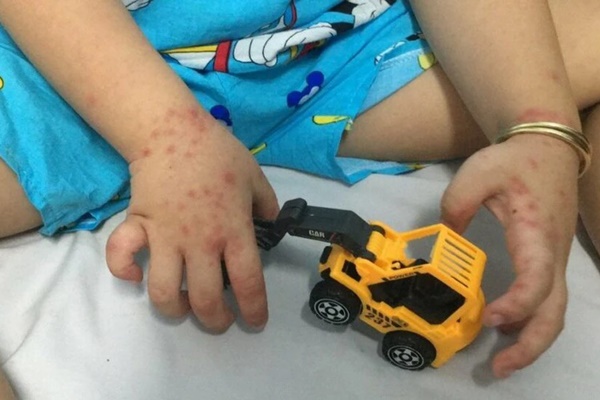 Cảnh giác với chủng virus tay chân miệng nguy hiểm đang gia tăng, nhiều trẻ không có biểu hiện rõ ràng, khó phát hiện-1