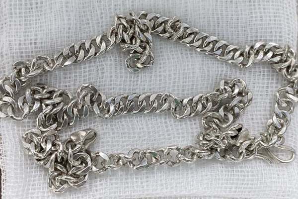 Bé 6 tuổi nhập viện cấp cứu vì nuốt sợi dây chuyền-1