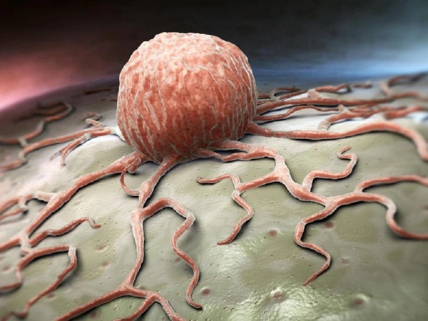 Bị ung thư có nên đụng dao kéo qua cách lý giải của bác sĩ-2