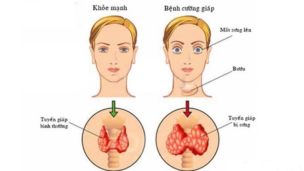 Căn bệnh cường giáp như hoa hậu Phương Khánh đang điều trị ảnh hưởng thế nào với phụ nữ?-2