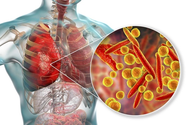 Bác sĩ cảnh báo các dấu hiệu nghi ngờ viêm phổi do vi khuẩn Mycoplasma-1