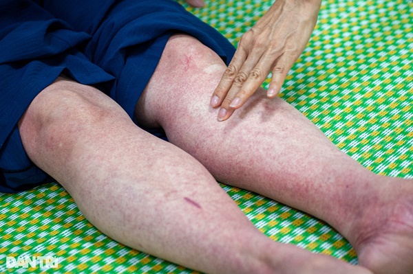 Hà Nội: Dịch bất thường, bệnh nhân ám ảnh vì cô đặc máu-8