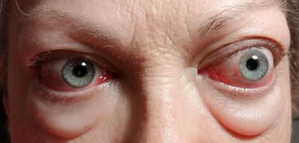 9 nguyên nhân không ngờ gây suy giáp được bác sĩ ung bướu chỉ rõ-3