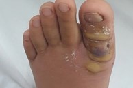 Thiếu nữ nhập viện sau khi nhổ sợi lông chân