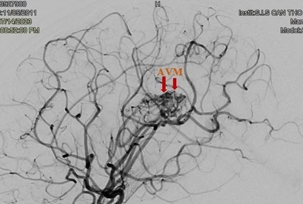 Bé gái 12 tuổi bị đột quỵ-1