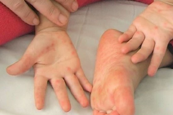 Gia tăng các bệnh truyền nhiễm, cách nào phòng bệnh cho trẻ?