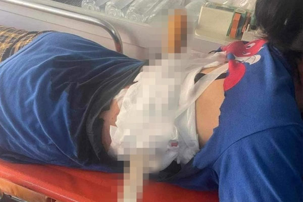 Người phụ nữ ở Hà Tĩnh bị chồng dùng dao nhọn phóng xuyên lưng-1