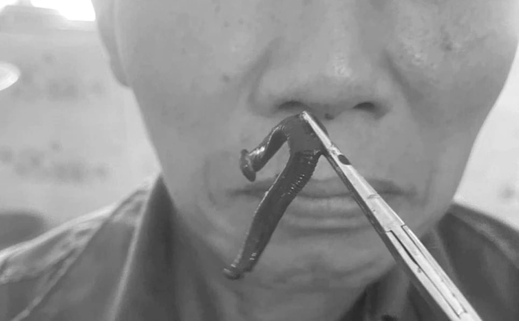 Ngạt mũi, chảy máu mũi suốt 2 tuần vì dị vật sống làm tổ trong mũi-1