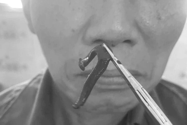 Lấy dị vật kim khí hình chữ U trong thực quản bé 8 tuổi-2