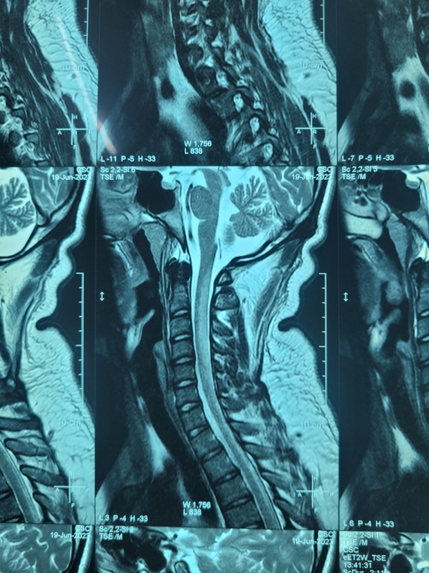 Thường xuyên hít bóng cười, cô gái trẻ ở TP.HCM tổn thương tủy sống cổ-2