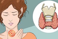 Xuất hiện 10 dấu hiệu sau chứng tỏ tuyến giáp đang hoạt động kém, cẩn trọng với bệnh suy giáp