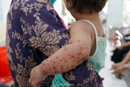 Vào 'điểm nóng' đang điều trị hàng trăm trẻ mắc tay chân miệng ở TPHCM