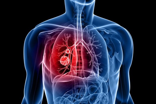 Tăng cường tầm soát ung thư phổi để tăng cơ hội sống cho bệnh nhân-1